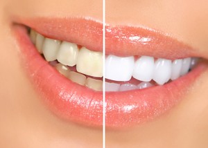 toothwhitening_clip_image003