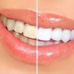 toothwhitening_clip_image003
