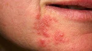 dermatitas